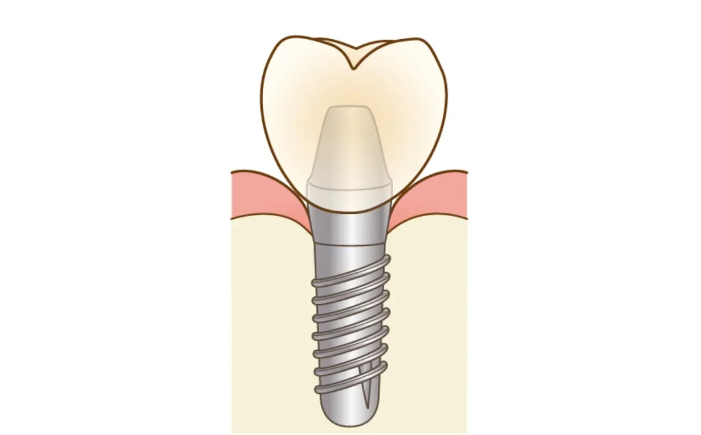 インプラント